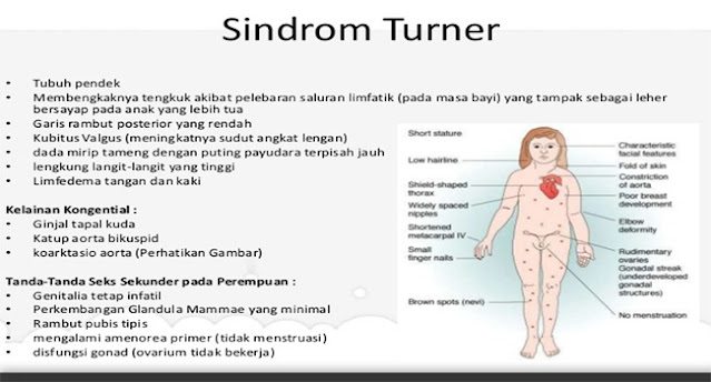 Sindrom Turner, Sindrom Turner pada wanita, Henry Turner, apa itu Sindrom Turner, bahaya Sindrom Turner, waspada Sindrom Turner, Sindrom Turner pada anak