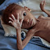 Καμπανάκι από τον ΟΗΕ για τον υποσιτισμό παιδιών στην Υεμένη: «Έχει φτάσει σε πρωτόγνωρα επίπεδα»