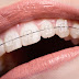 Niềng răng có đau không? Quy trình niềng răng thế nào?