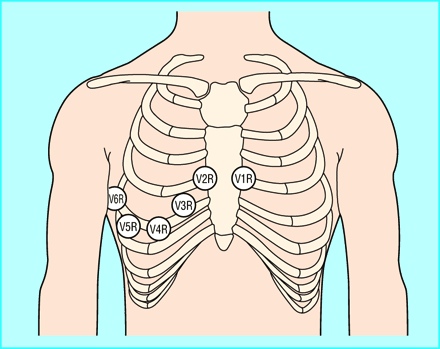 Paucis Verbis: Right and posterior EKG leads | little white coats