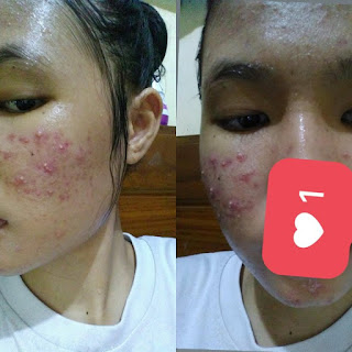 Perjuangan Melawan Jerawat Dengan Skincare di Bawah 100k