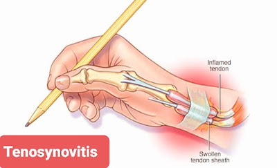 إلتهاب غمد الوتر  يسمى التهاب غمد الوتر بالانجليزي Tenosynovitis
