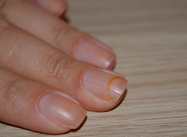 ониходистрофия борозды. каналиформная дистрофия ногтей. модный маникюр с волнистыми линиями 2022. летний волнистый маникюр. фото волнистых ногтей.