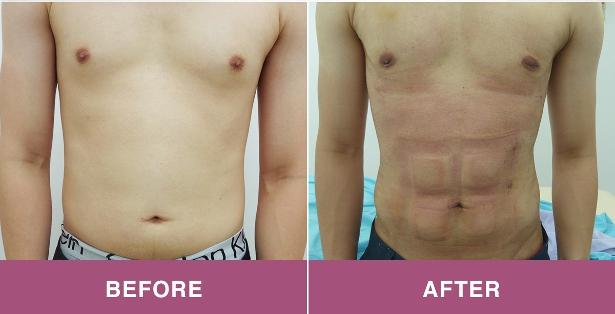 Interplast Clinic Six Pack Surgery Before And After Photos