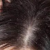 5  وصفات طبيعية لإزالة القشرة من الشعر