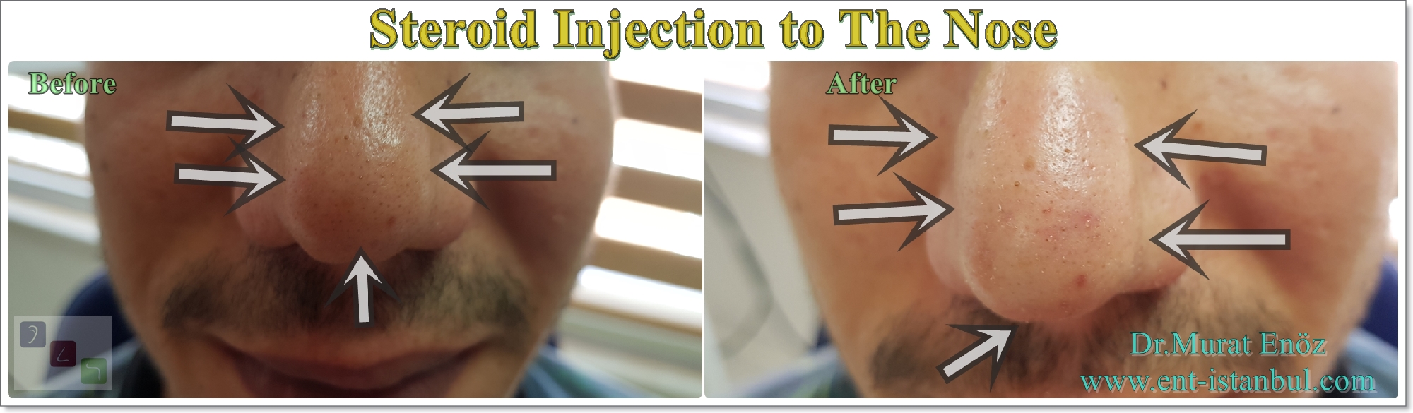 Steroid Injection After Rhinoplasty