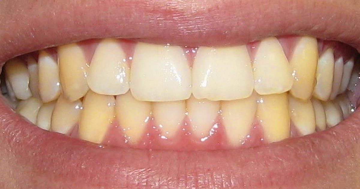 ¿Por qué se ponen los dientes