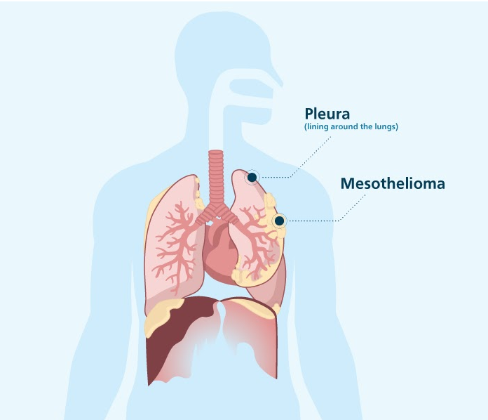 Mesothelioma Symptoms Causes Diagnosis