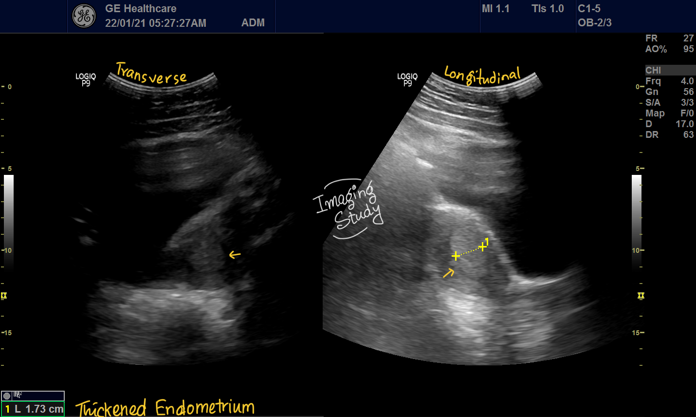 Case 26 Thickened Endometrium Imaging Study