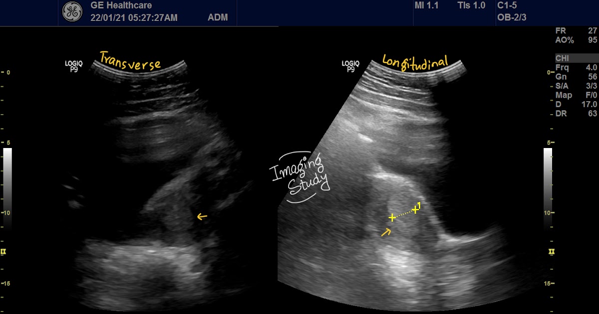 Case 26 Thickened Endometrium Imaging Study