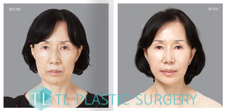 Tl Anti Aging Lifting Korea Smas Facelift
