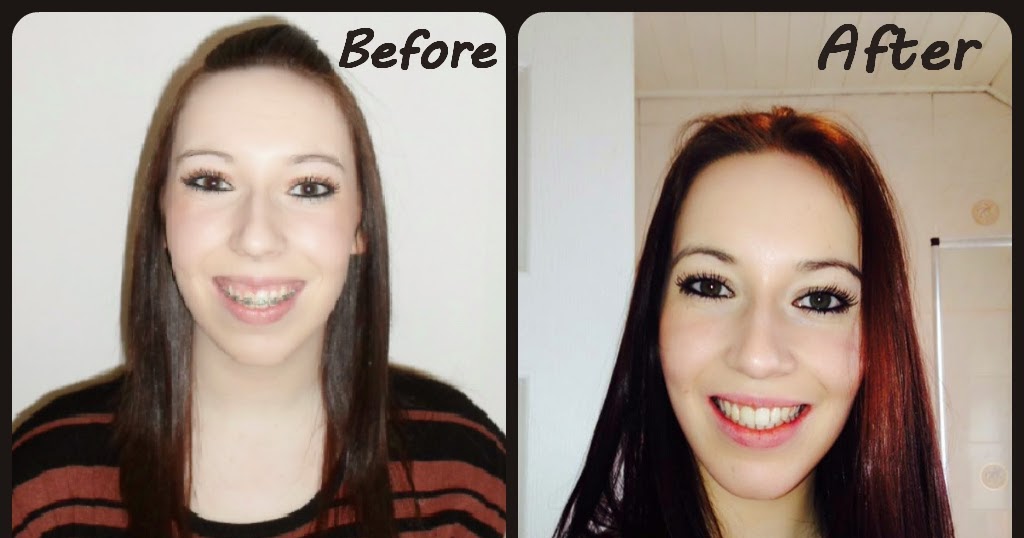 My Jaw Surgery And I 1 Year Post Op More Pictures