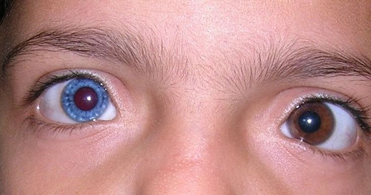 david bowie heterochromia