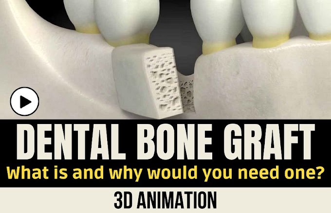 DENTAL BONE GRAFT: What is and why would you need one? 