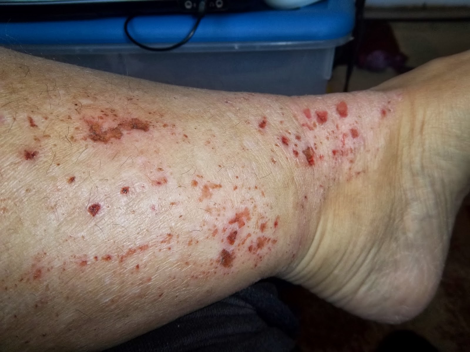 stopping-topical-steroids-flare-subsided-today-but-damage-already-done