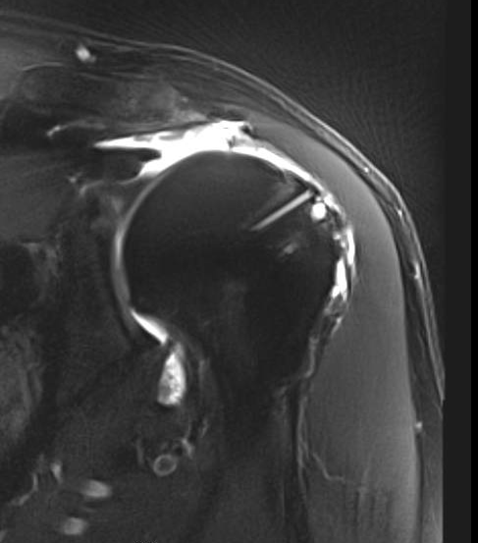 Shoulder Arthritis/Joint Replacement Rotator cuff tears Irreparable