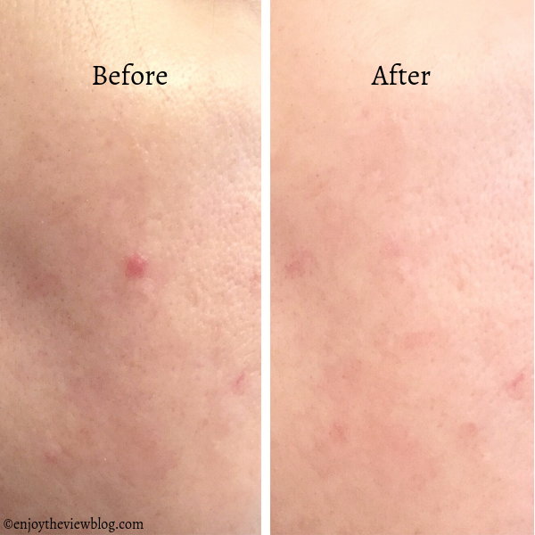 OTC Treatment for Rosacea Symptoms: Prosacea® | {enjoy the view}