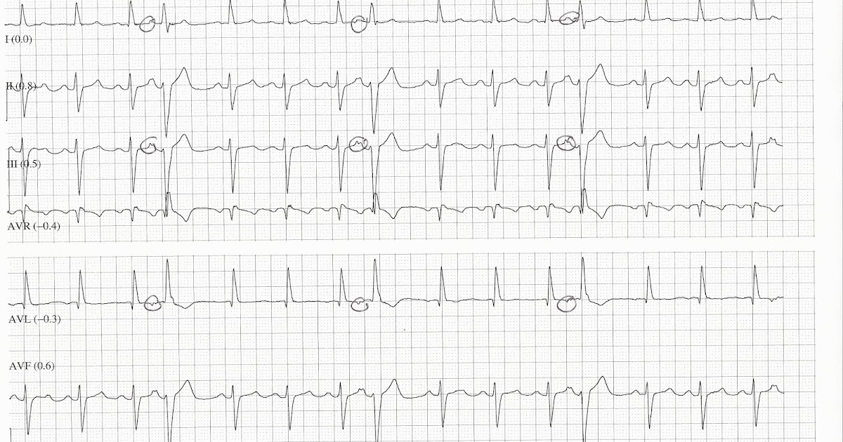 Bigeminal dropped PACs