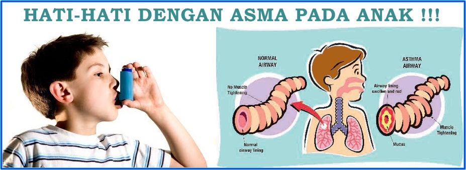 Cetosis para asma