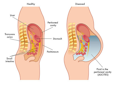 Tiếp cận và xử trí báng kháng trị ở bệnh nhân xơ gan