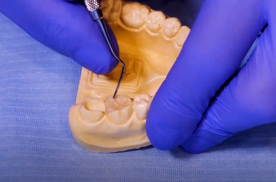 COMPOSITE RESTORATION Indirect/Direct Composite Inlays step by step