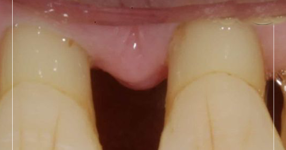 Diş Eti Hastalığı Nasıl Önlenir ve Nasıl Tedavi Edilir Pratik Tarifim