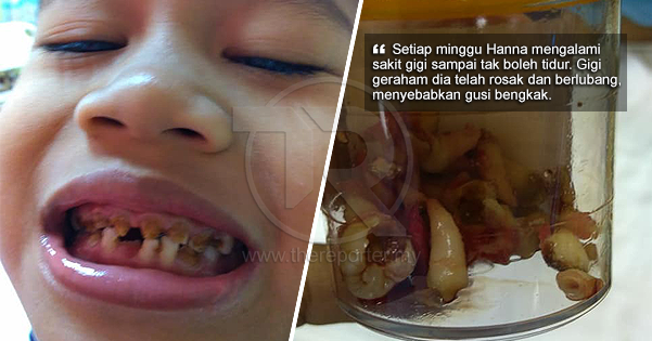 Kuat Minum Milo Dan Malas Gosok Gigi Doktor Terpaksa Cabut Semua Gigi The Reporter