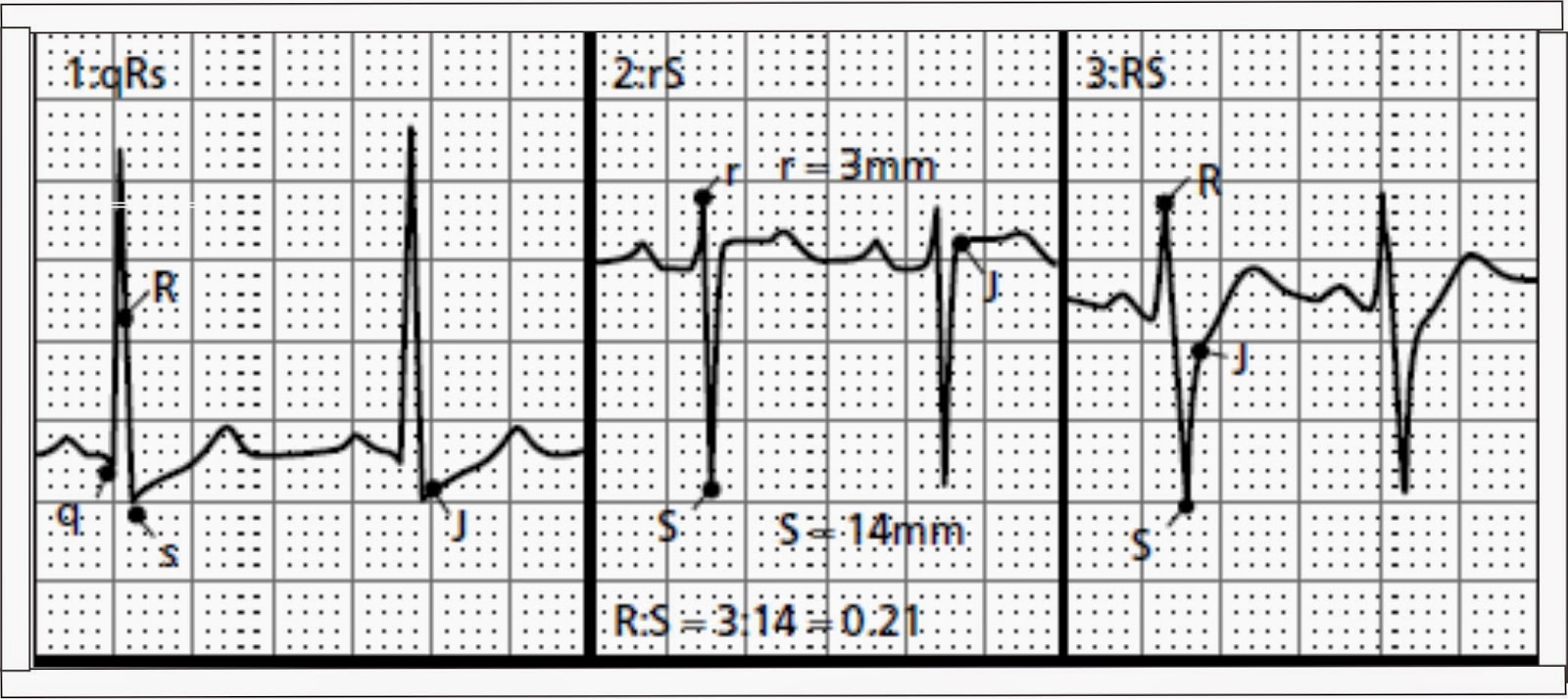 расширенный qrs на экг. измененный комплекс qrs.