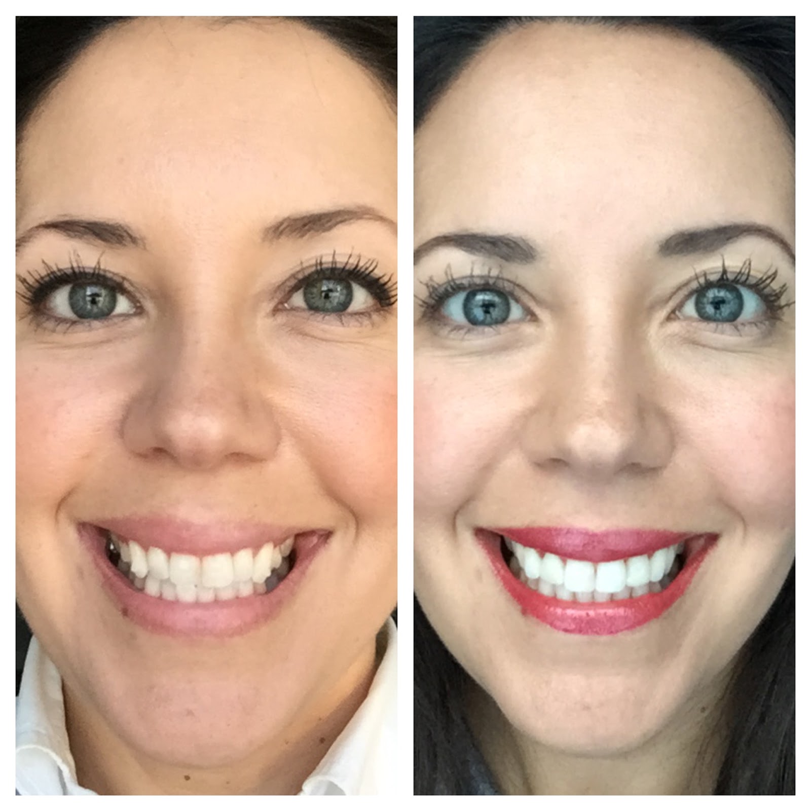 Things to Consider During Your Invisalign Treatment