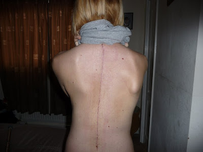 My scoliosis scar a few weeks after surgery
