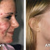 Effective Natural Ways To Get Rid Of Pimples!