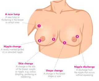 ಸ್ತನ ಕ್ಯಾನ್ಸರನಿಂದ ಹುಷಾರಾಗಿರಿ : Breast Cancer in Kannada