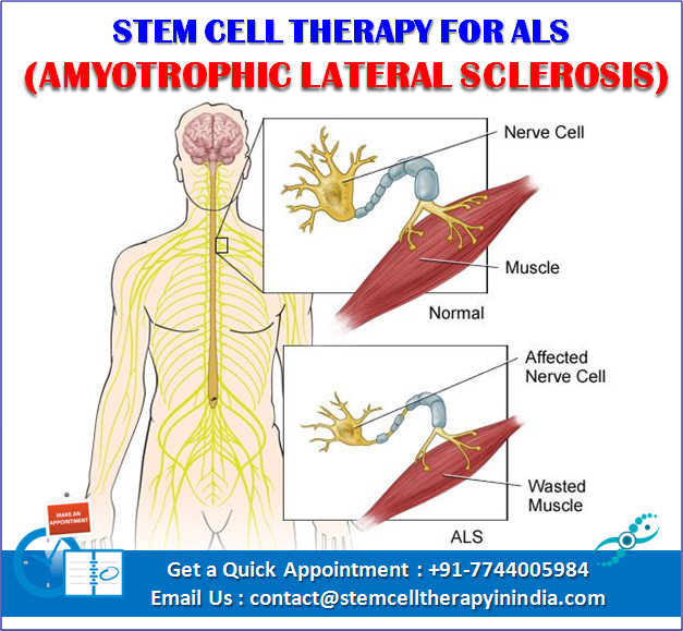 ALS Stem Cell Therapy in India