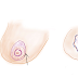 Areola reduction, Breast surgery Korea KIES-U