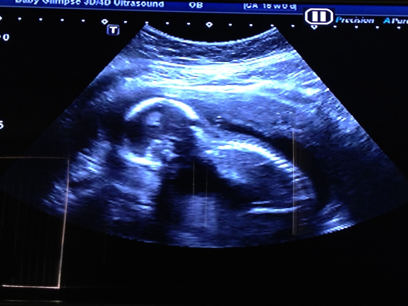 Baby Ultrasound Upside Down Baby Ultrasound