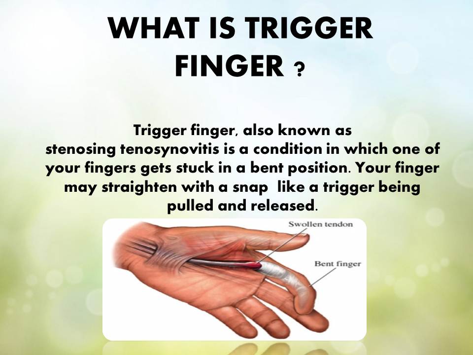 [DIAGRAM] Diagram Of Trigger Finger