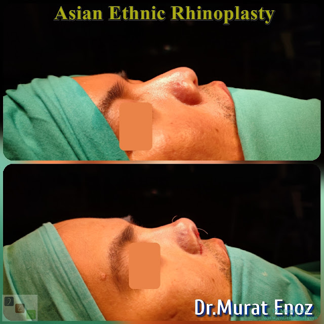 Asian Ethnic Nose Job - Asian Ethnic Rhinoplasty in Istanbul