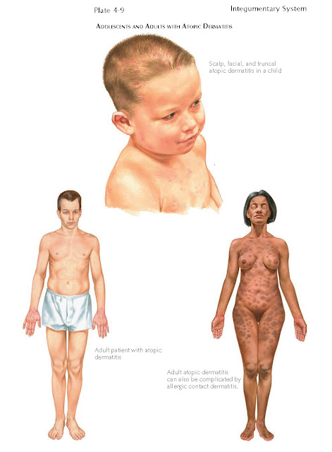 ADOLESCENTS AND ADULTS WITH ATOPIC DERMATITIS