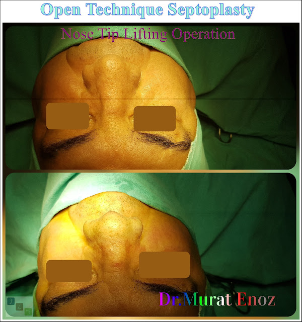 Nose tip lifting in İstanbul,Open technique nose tip plasty in İstanbul,open technique septoplasty in İstanbul,Open tecnique septoplasty operation,Nose tip lifting in Turkey,