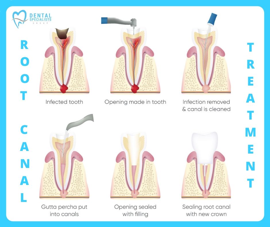 What is an endodontic treatment and why do teeth need it?