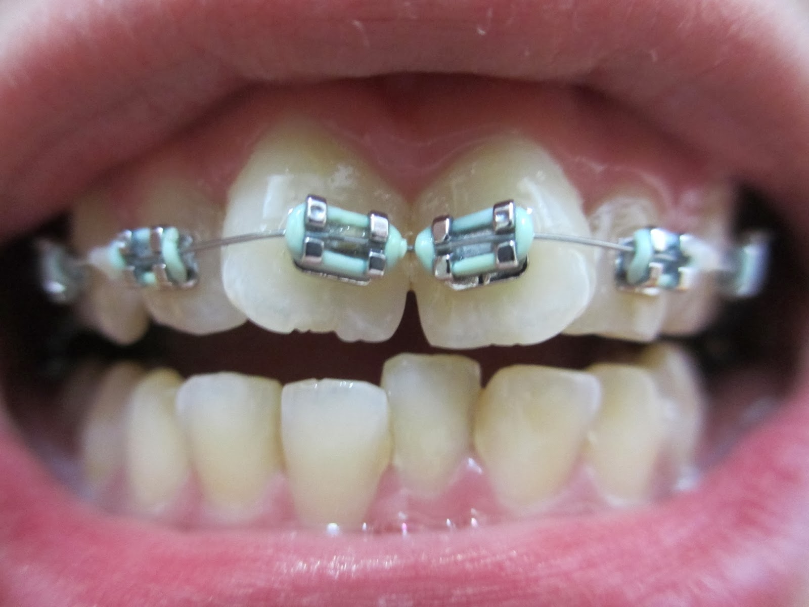 Dear you. 5th Appointment Bottom Braces, Cleaning & Polishing
