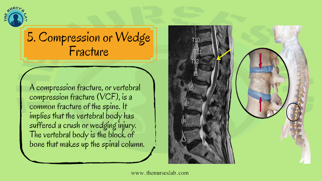 Types of Bone Fracture