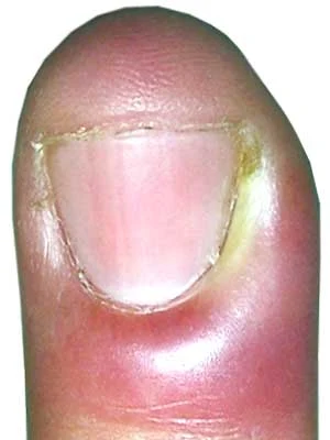 Paronychia