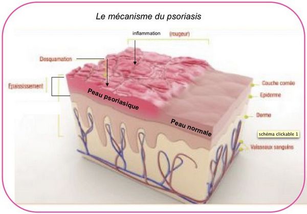 Psoriasis : plaques rouges à certains endroits du corps