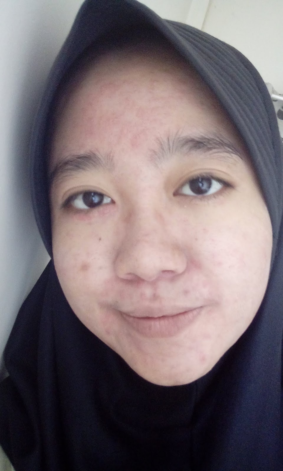 Pengalaman Lepas dari Produk Natasha Skin Care (Bagian 2)