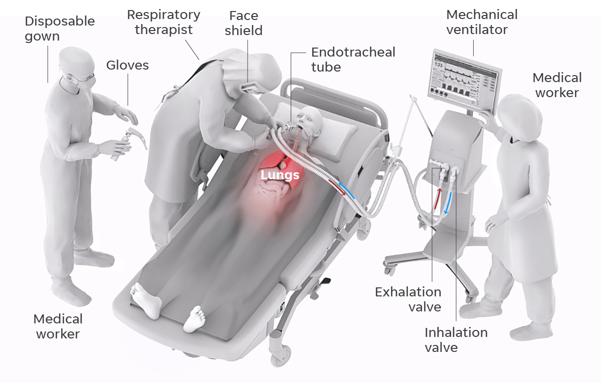 BAGAIMANA ALAT VENTILATOR BERFUNGSI?