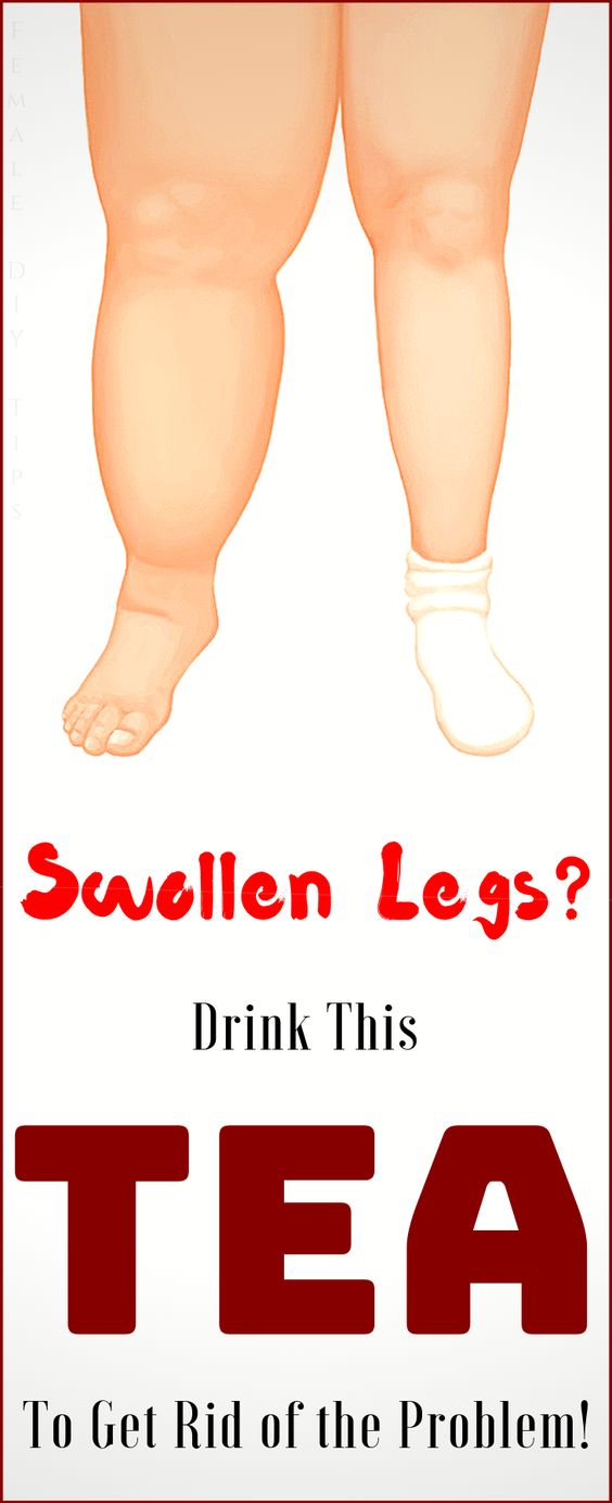 Do You Have Problems with Swollen Feet? This Powerful Tea is the Best
