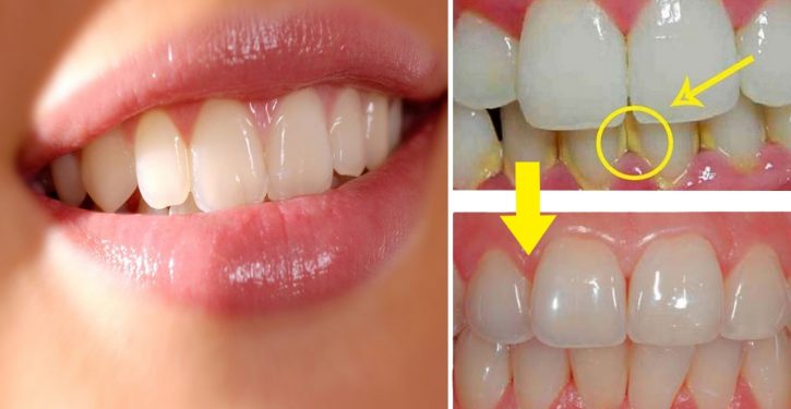 Remove All Tartar From Your Teeth With This Natural Mix! It's Fast And Easy!