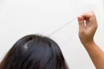 Hair Loss Due To Stress And Anxiety Hair Loss Due To Stress And Anxiety