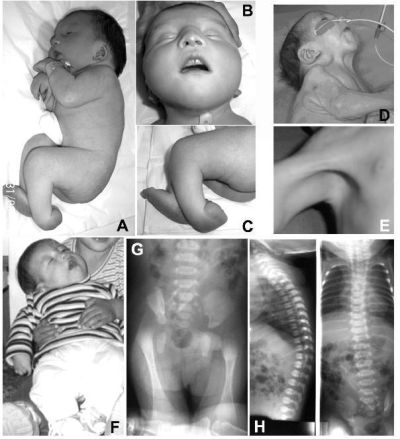 Image result for Artrogriposis